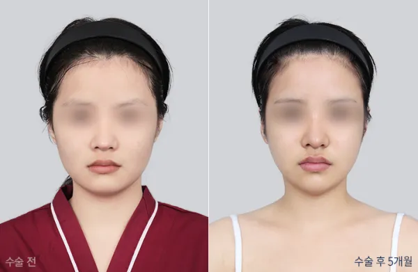 Before/After