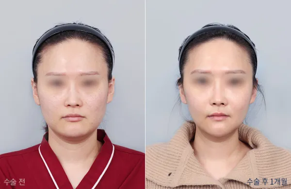 Before/After