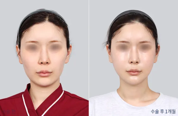 Before/After