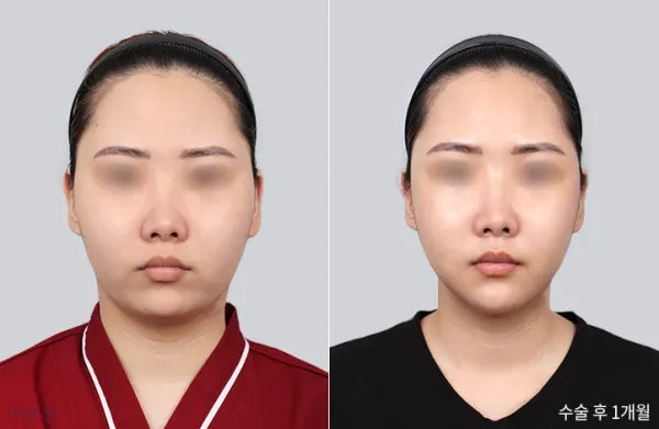 Before/After