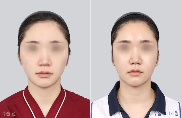Before/After