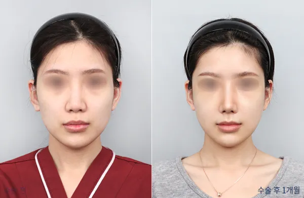 Before/After