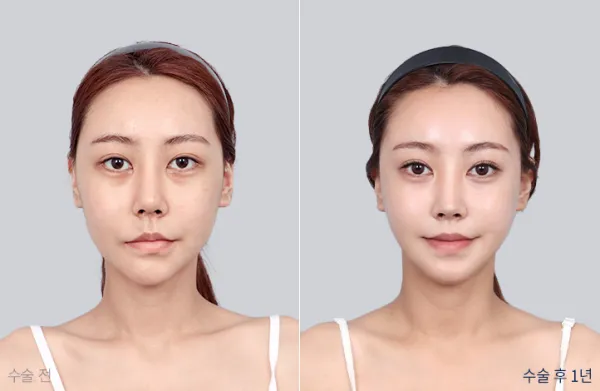 Before/After