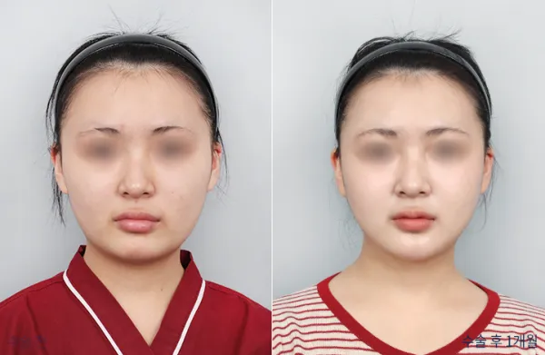 Before/After