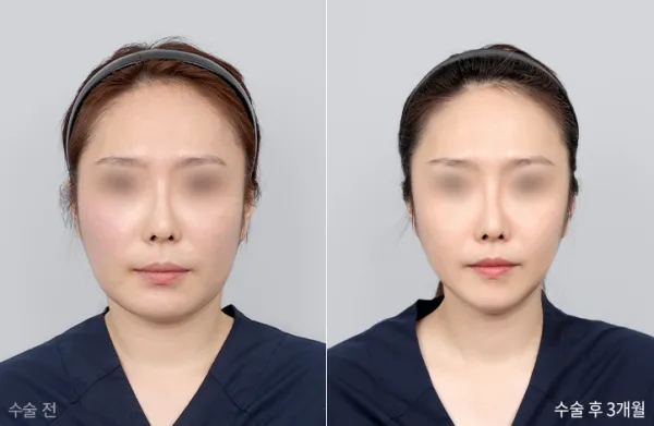 Before/After