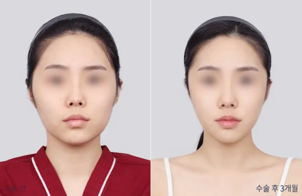 Before/After