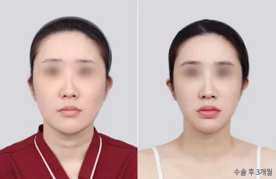 Before & After