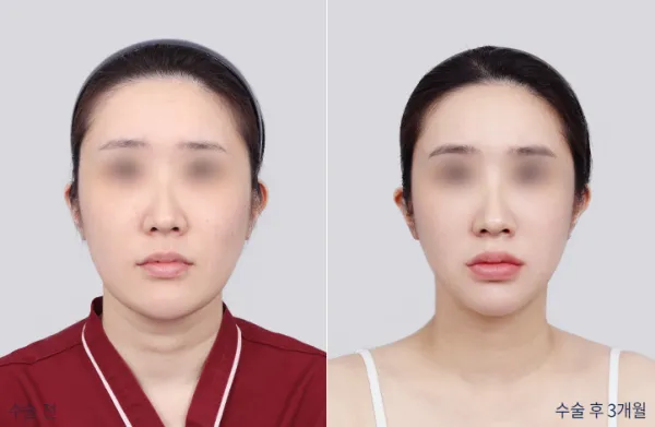 Before/After