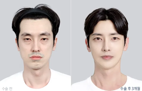 Before/After