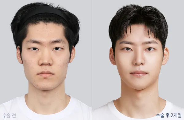 Before/After