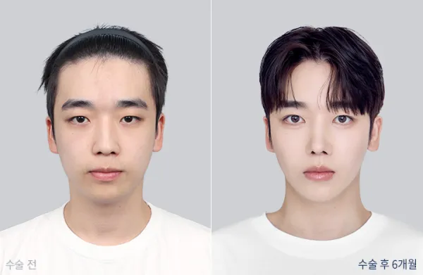 Before/After