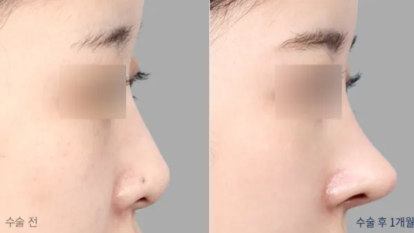 Before/After