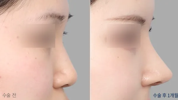 Before/After