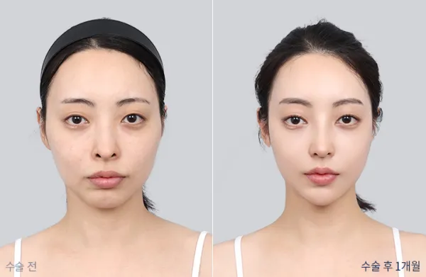 Before/After