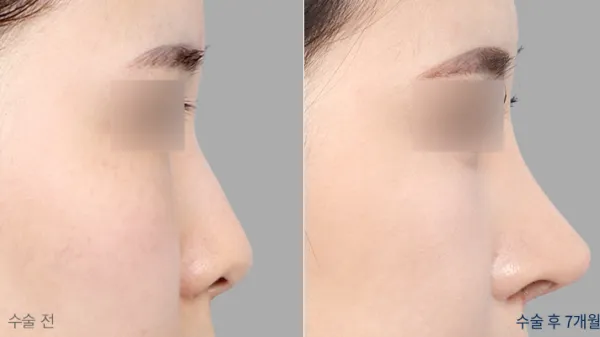 Before/After