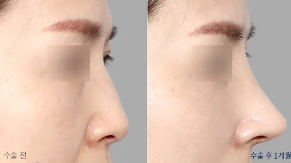 Before/After