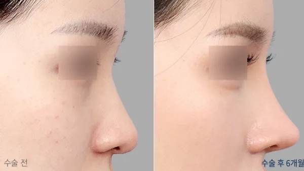 Before/After