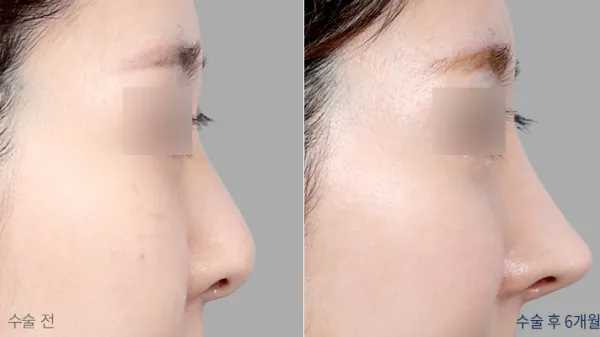Before/After