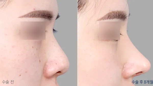 Before/After