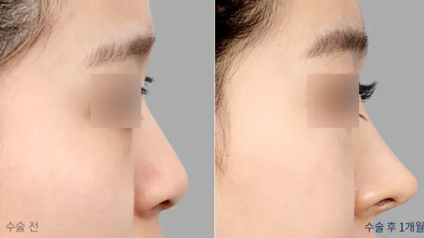Before/After