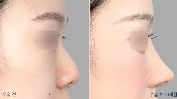 Before/After