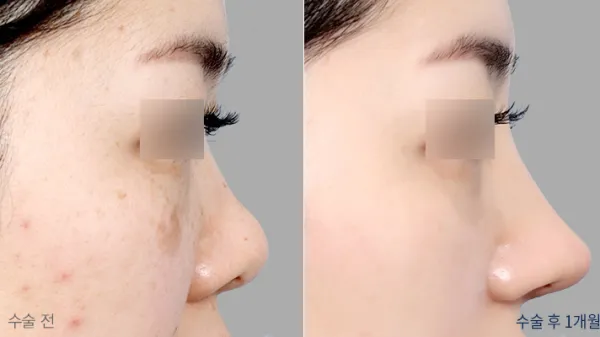 Before/After