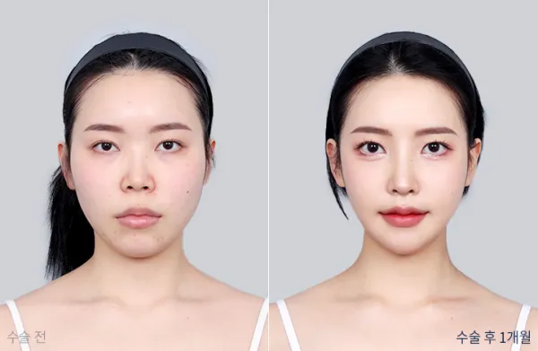 Before/After