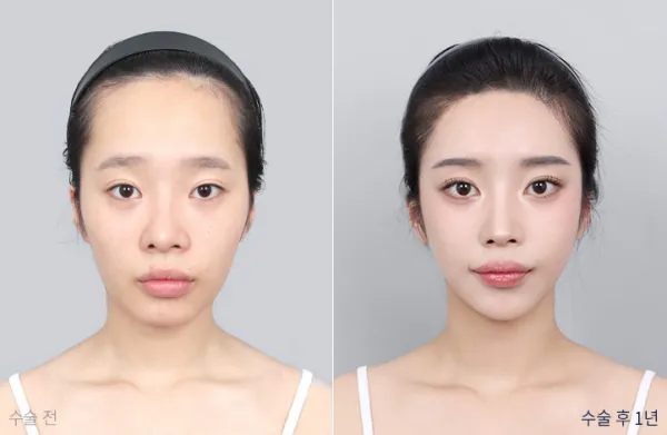 Before/After