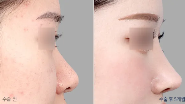 Before/After
