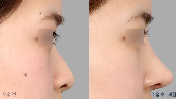 Before/After