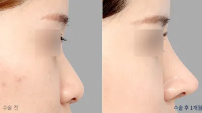 Before & After