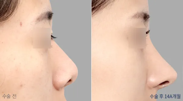 Before/After