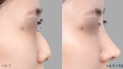 Before & After