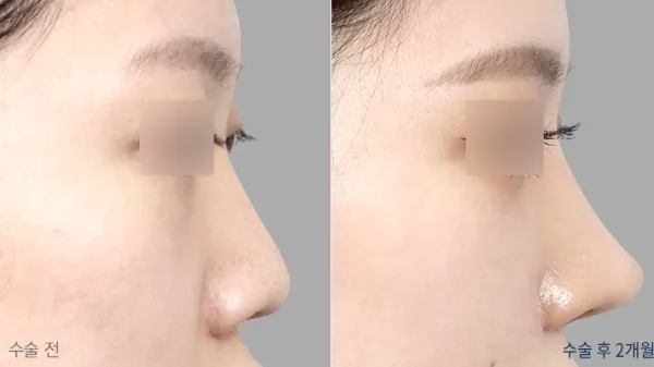 Before/After