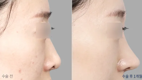 Before/After