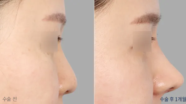 Before/After