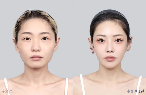 Before/After