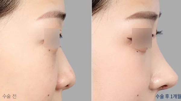 Before/After