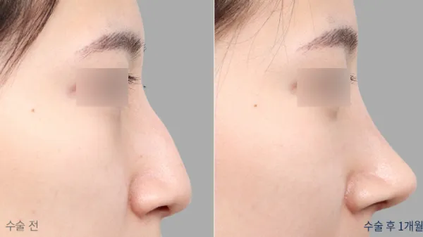 Before/After