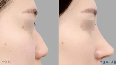 Before & After