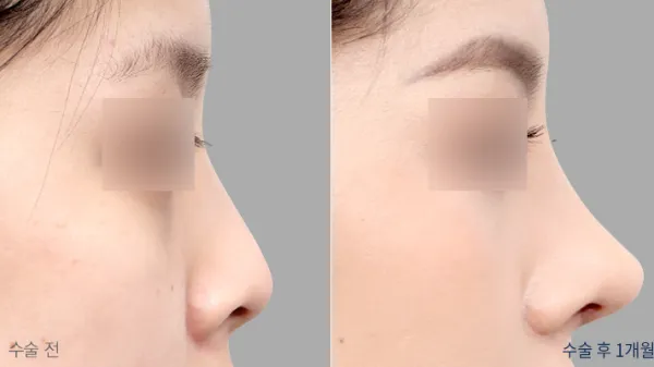 Before/After