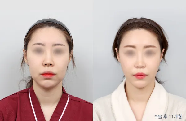 Before/After