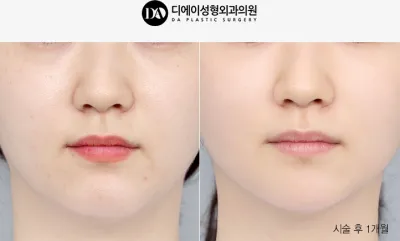 Before & After