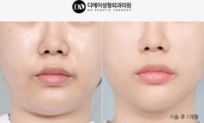 Before & After