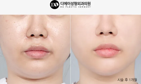 Before/After