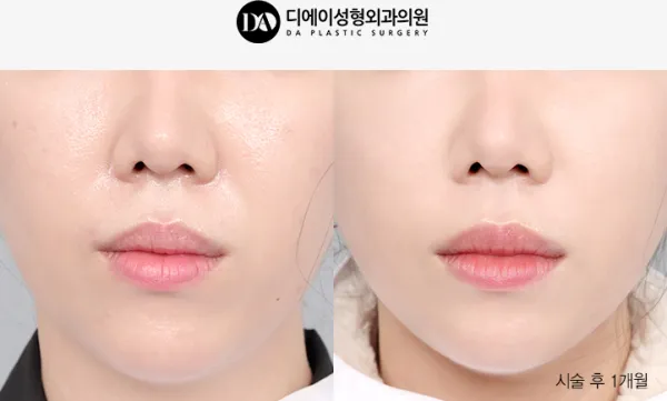 Before/After