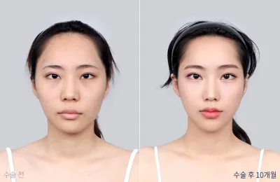 Before & After