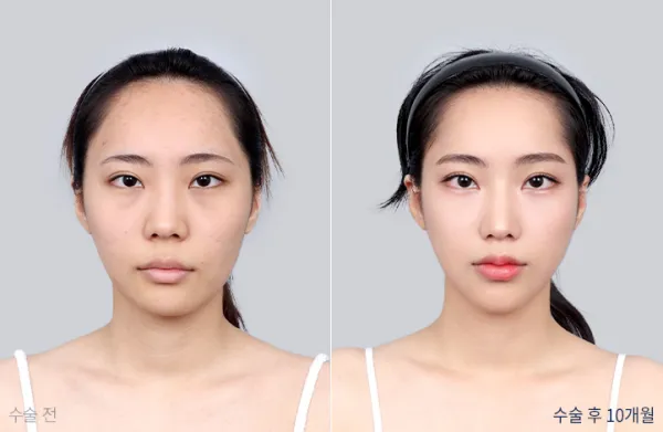 Before/After