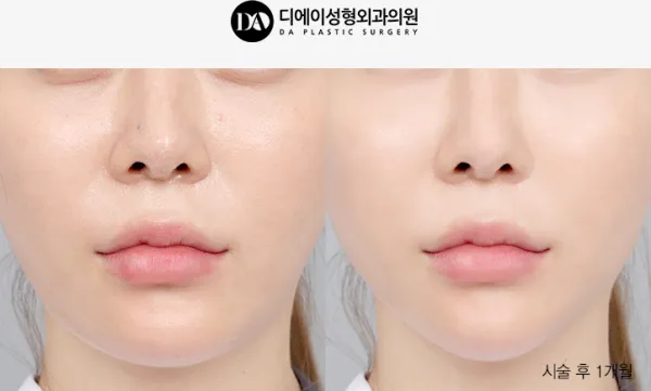 Before/After