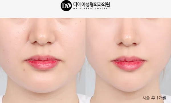Before/After